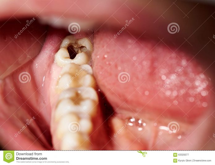 kerusakan-gigi-tooth-decay